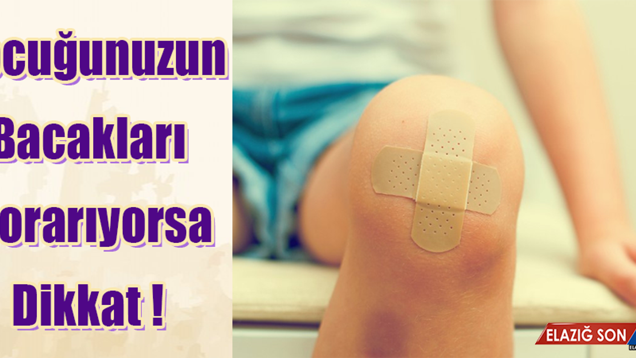 Çocuğunuzun Bacakları Morarıyorsa Dikkat