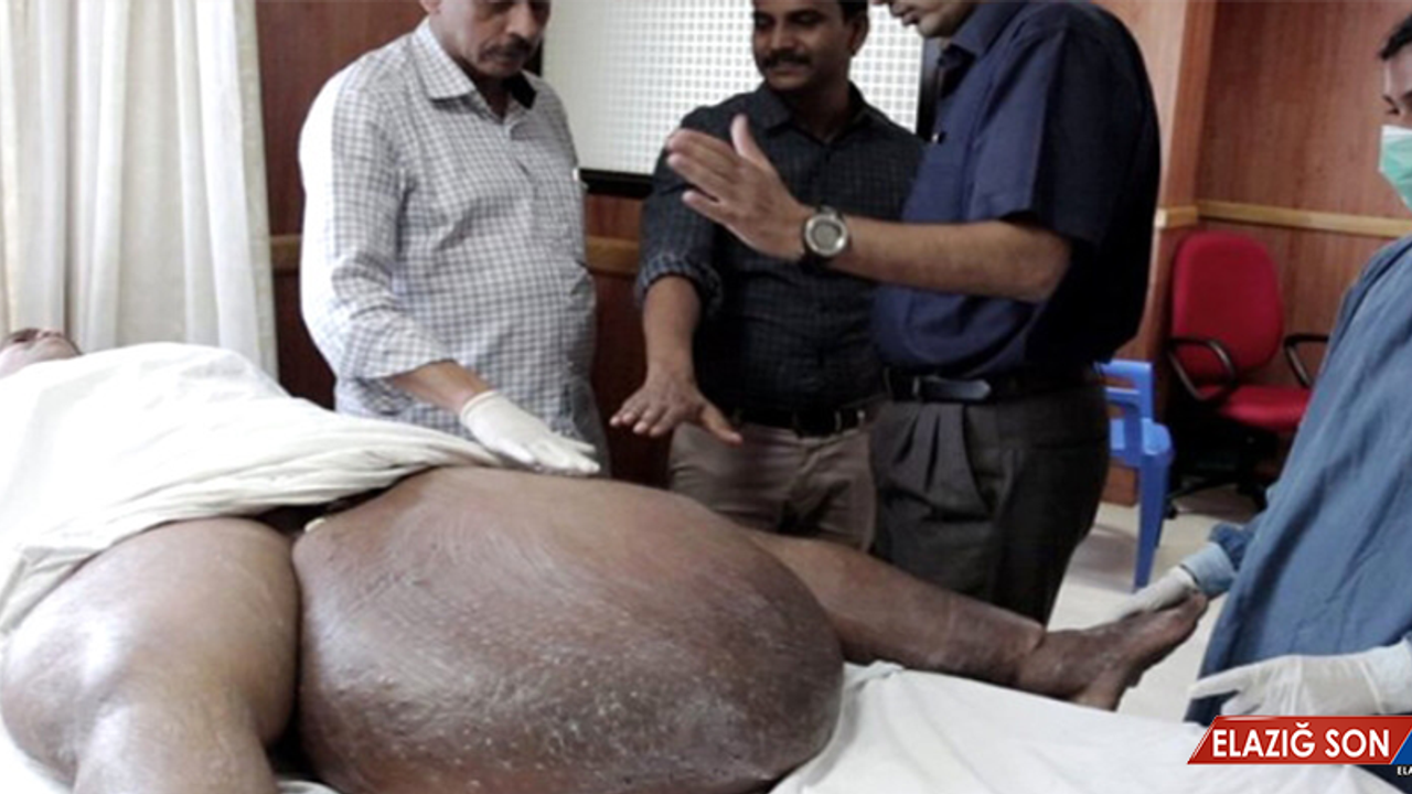 Hindistanlı Adam Sivrisinekten Kaptığı Parazit Yüzünden Hareket Edemez Hale Geldi