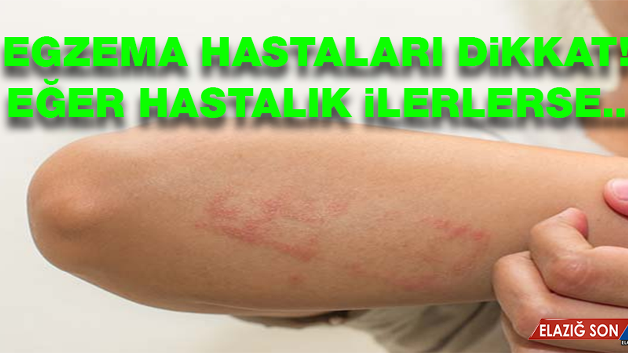 İlerleyen egzama kalp rahatsızlığı riskini arttırabilir!