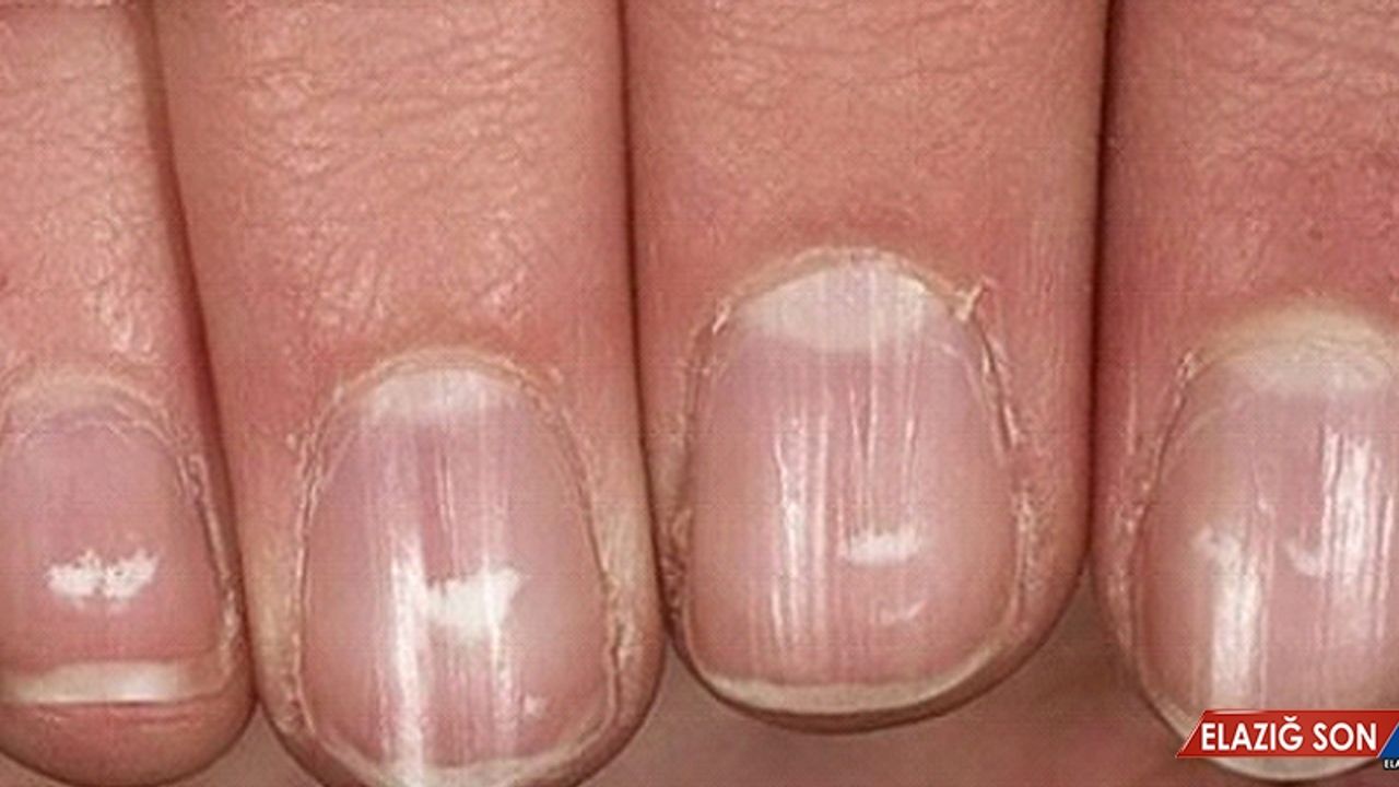Tırnaklardaki Beyaz Lekeler Bazı Hastalıkların Habercisi