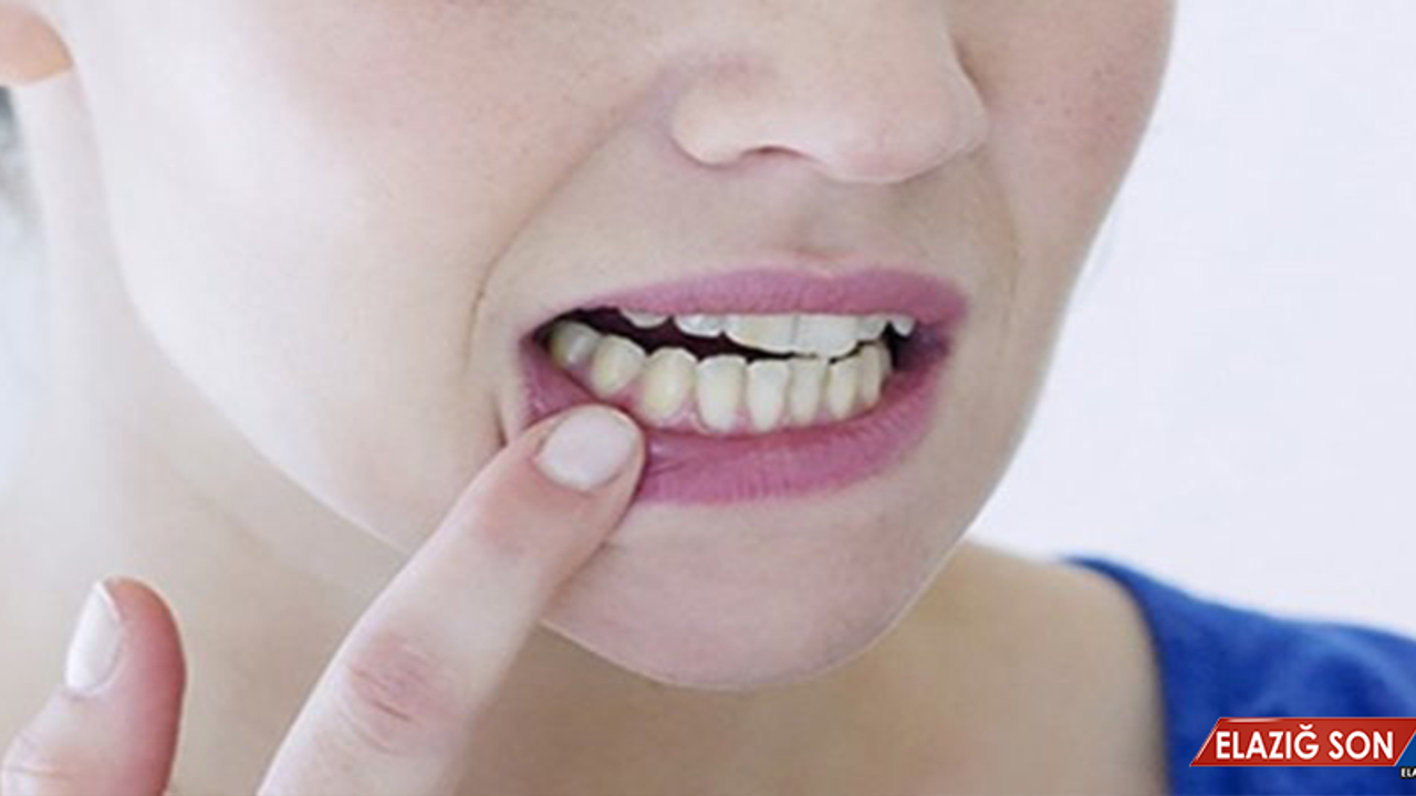 Aft Neden Olur, Nasıl Tedavi Edilir?