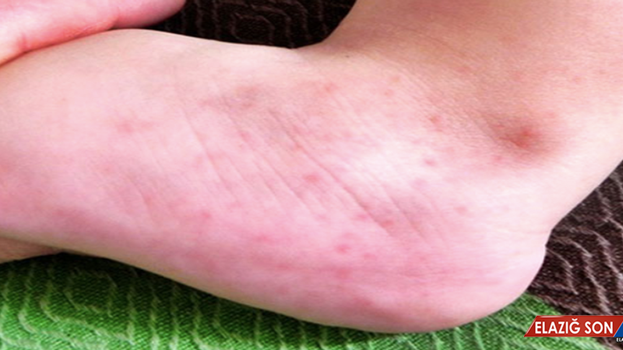 Ayakta Görülen Lekeler Kırmızı Lekeler Ayakta Neden Olur