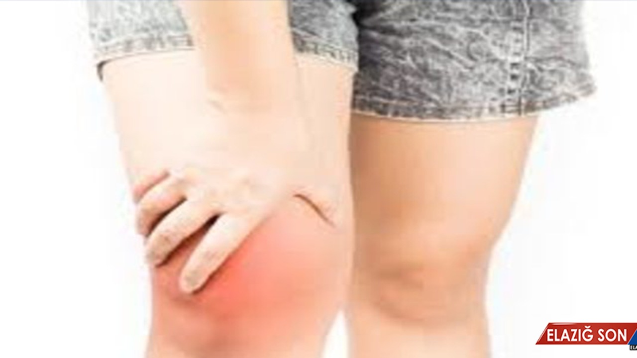 Ödem Neden Olur, Nasıl Tedavi Edilir?