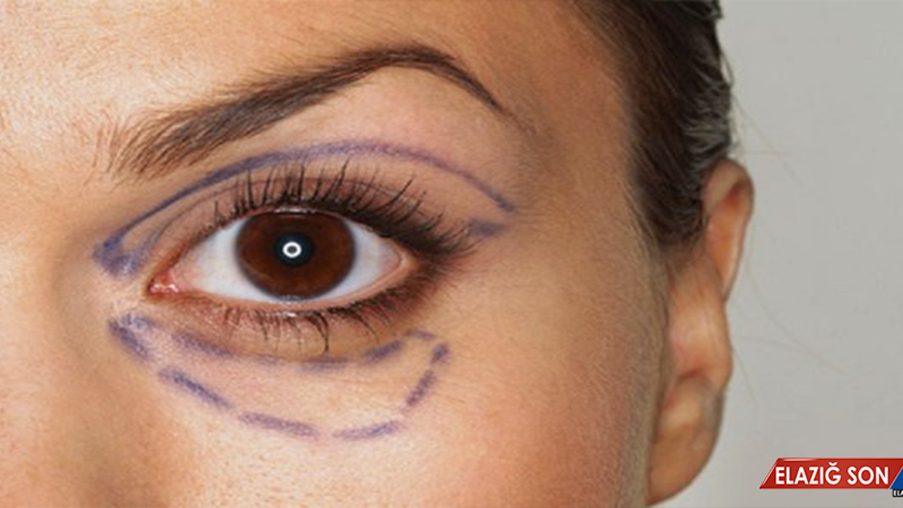Göz Kapağı Estetiği İle Gençleşmek Mümkün!