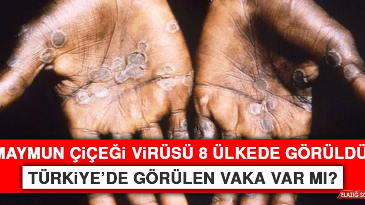 Türkiye’de Maymun Çiçeği Virüsü Vakası Var mı?