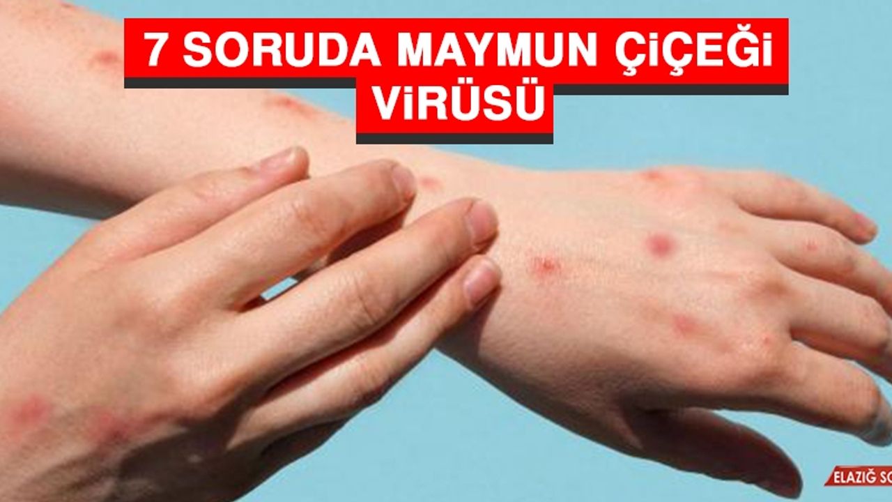 7 Soruda Maymun Çiçeği Virüsü