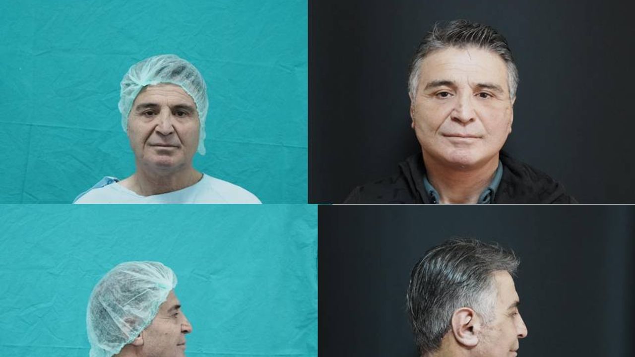 Bitlis'te ilk kez 'derin plan yüz germe ameliyatı' yapıldı