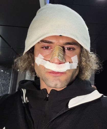 Elazığspor’da Fuat Bavuk’un Burnu Kırıldı