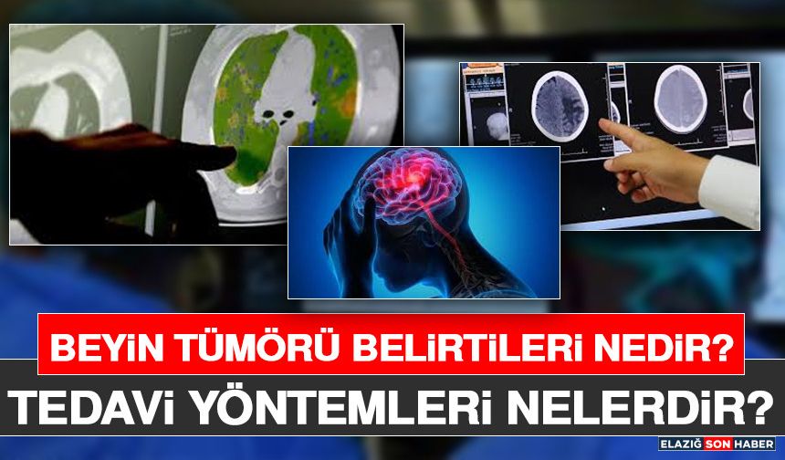 Beyin Tümörü Belirtileri Nedir? Tedavi Yöntemleri Nelerdir?